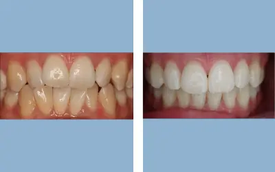 Before and After